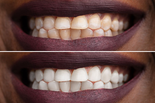 Benefits of Professional Teeth Whitening Sessions from Smiles By Julia in Fort Lauderdale, FL
