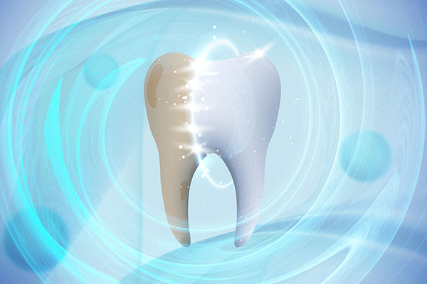 CEREC Crowns Are Polished And Bonded In Place