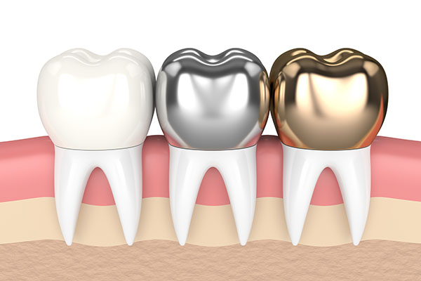 CEREC Crowns Vs Traditional &#    ; Which Is Better, Bonded Or Cemented In Place?