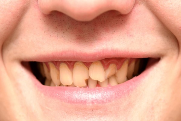Fillings, Bonding Or Veneers? Solution Options For A Chipped Tooth