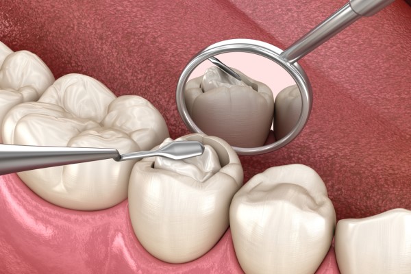 How A Dentist Treats A Loose Dental Filling