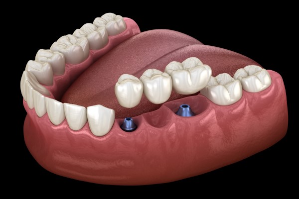 Consider Dental Bridges For A Durable And Non Surgical Restoration