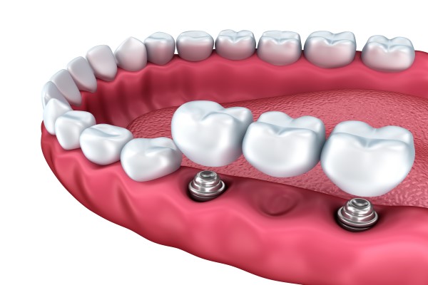How A Dental Bridge Can Replace A Missing Tooth