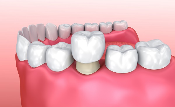 Implant Crowns Fort Lauderdale, FL