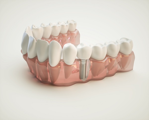 dental implants Fort Lauderdale, FL