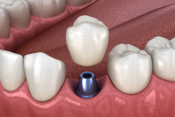 What To Do If An Implant Crown Falls Out