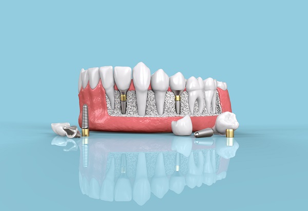 Why You Should Not Fear Surgery To Get Dental Implants