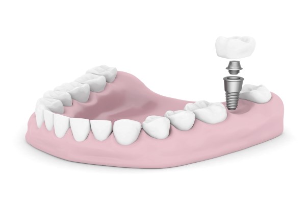 Cosmetic Dentistry For A Missing Tooth: Dental Implant