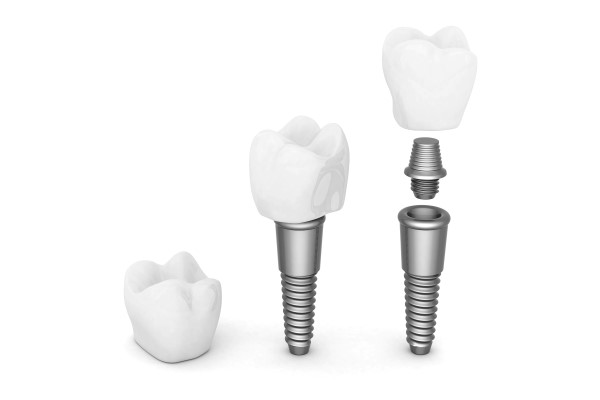 Replacing Missing Teeth &#    ; Timeline For Dental Implants