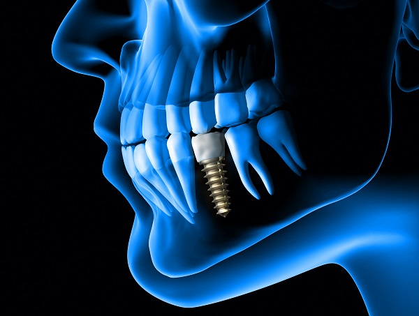 dental implant restoration Fort Lauderdale, FL