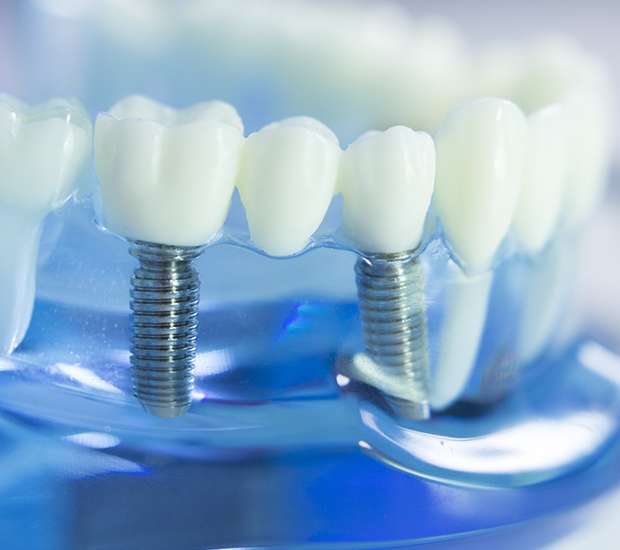 Fort Lauderdale Dental Implants