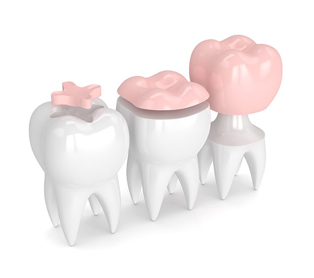 Fort Lauderdale Dental Inlays and Onlays