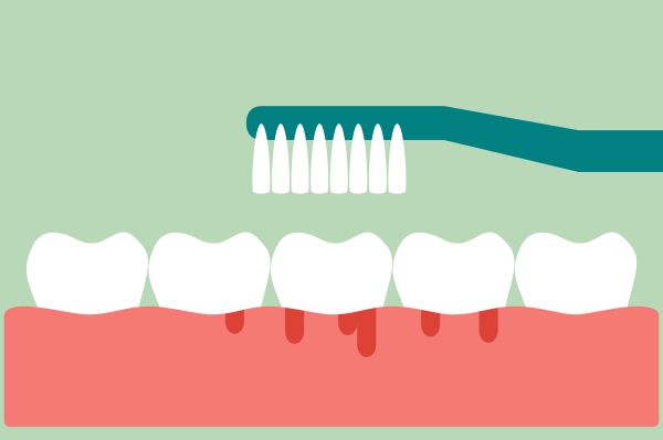 gum disease Fort Lauderdale, FL