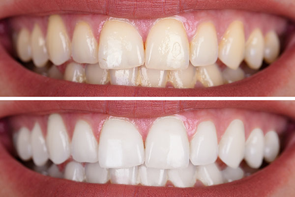 How Long do the Results of Teeth Whitening Treatments Last? from Smiles By Julia in Fort Lauderdale, FL