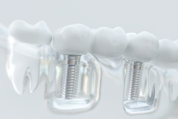 Implant Dentistry: FAQs