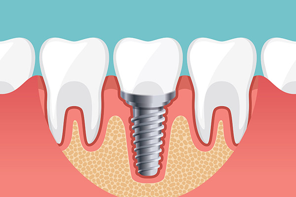 Implant Dentistry Options To Replace a Single Missing Tooth from Smiles By Julia in Fort Lauderdale, FL
