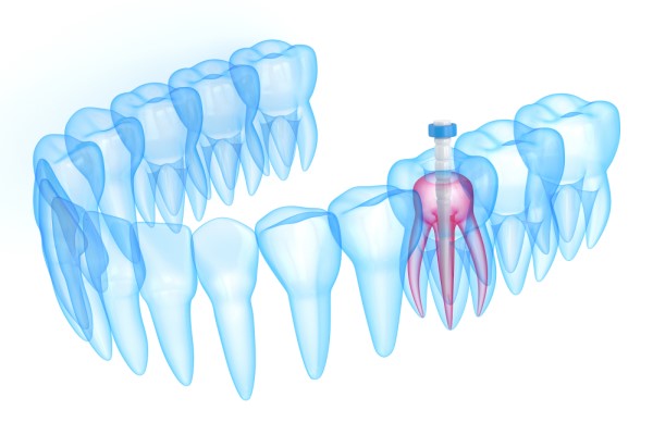 Root Canal Treatment Fort Lauderdale, FL