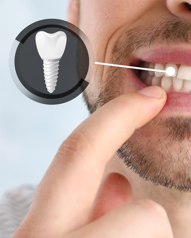 Dental Implants