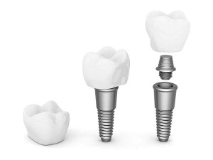 Dental Implants Dental Implants