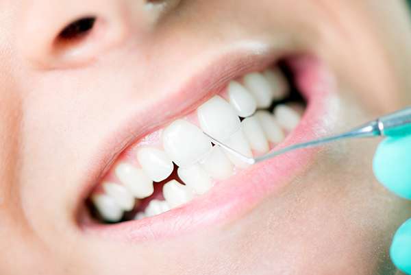 Dental Deep Cleaning Alternatives