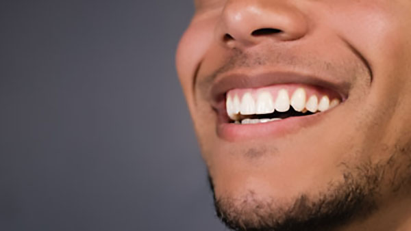 teeth whitening Fort Lauderdale, FL