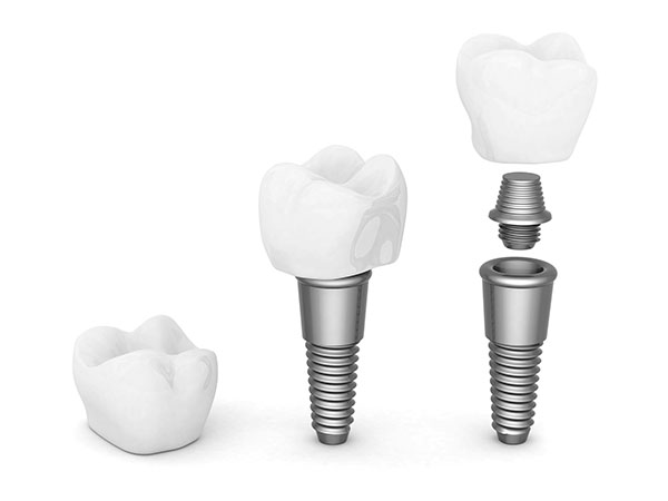 The Dental Implant Procedure