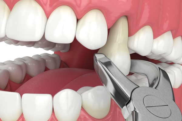 How To Take Care Of Your Mouth After A Tooth Extraction
