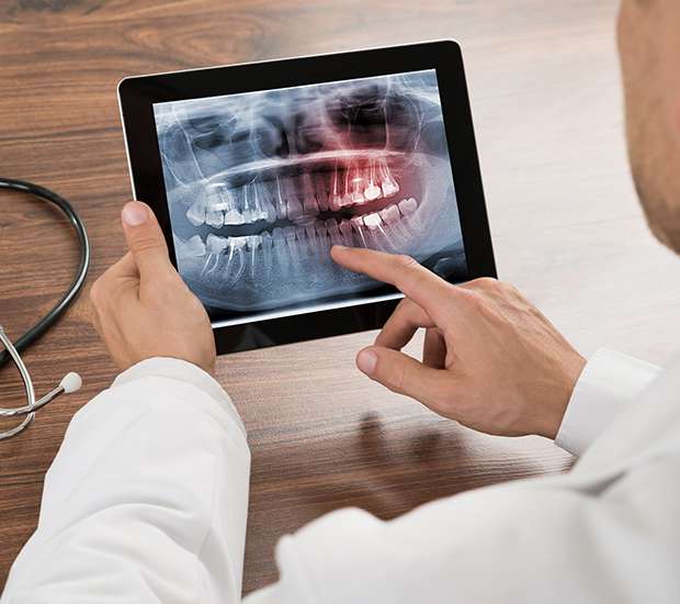 Fort Lauderdale Types of Dental Root Fractures