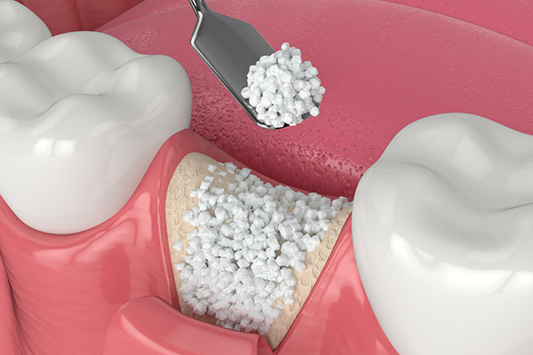 When a Bone Graft Is Needed for an Implant Dentistry Procedure from Smiles By Julia in Fort Lauderdale, FL