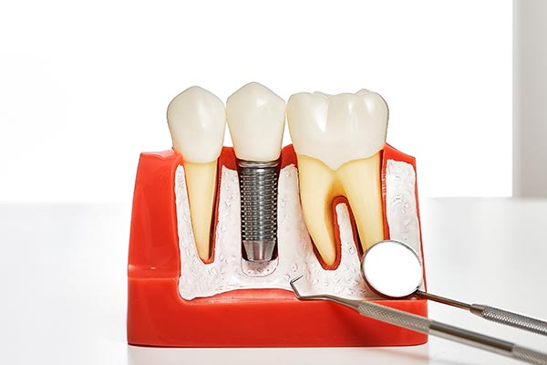 Your Guide to Different Kinds of Dental Implants from Smiles By Julia in Fort Lauderdale, FL