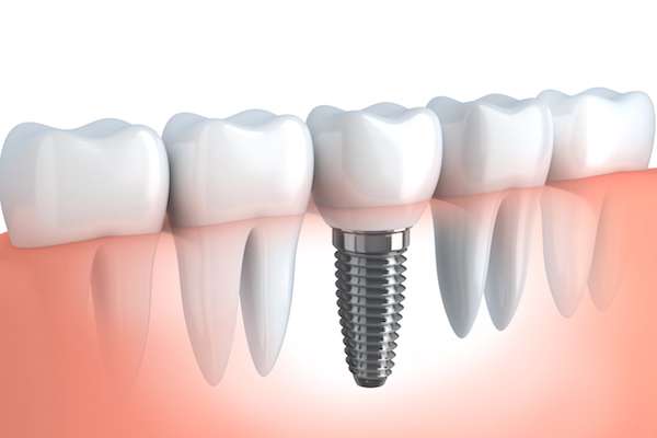 Your Ultimate Guide to Getting Dental Implants from Smiles By Julia in Fort Lauderdale, FL